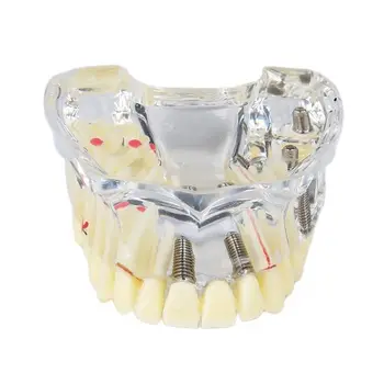 Zubné M2006 Implantát Model Zubné štandardné Školenia Model pre Študentov