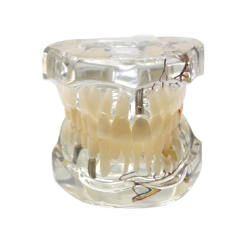 Vymeniteľné Patologické Zuby Model Zubný Implantát Model Zubov Implantát Model Výučby Učebné Dentálne Materiály